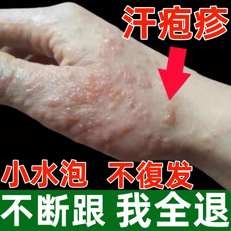 药膏汉状真菌感染手气膏-特价促销-优惠券领取-价格|多少钱|什么牌子