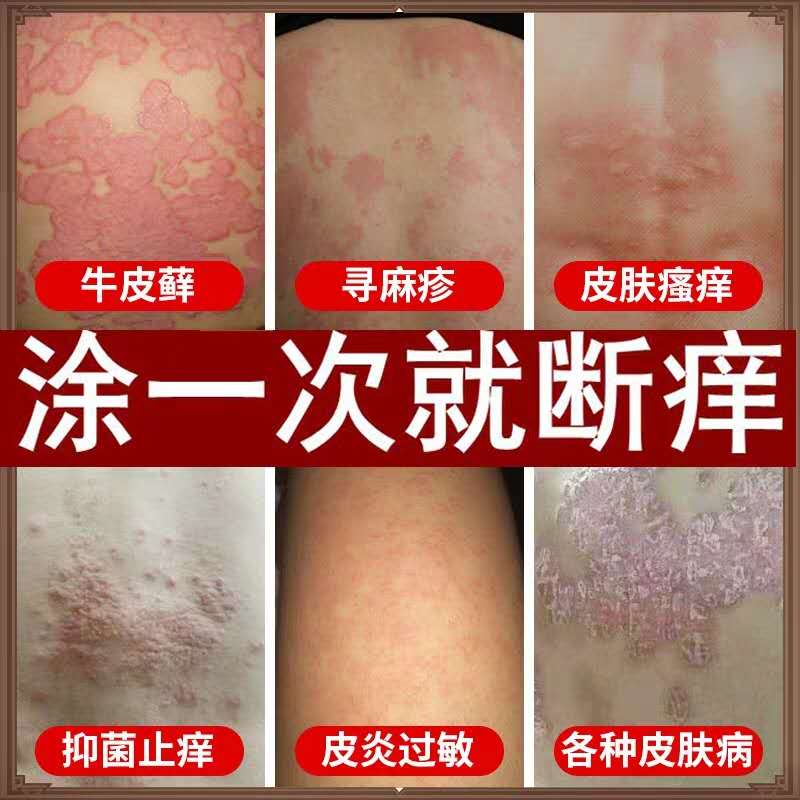 省2元 治疗手癣膏足藓膏脚癣脚痒真菌感染手足脱皮水泡汗疱疹的药膏