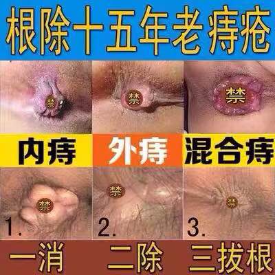 痔疮痣痔疮膏治疗男女内外混合肉球孕妇产后止血肛门