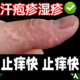 湿症膏，1 手上起水泡，皮肤痒 买二送一