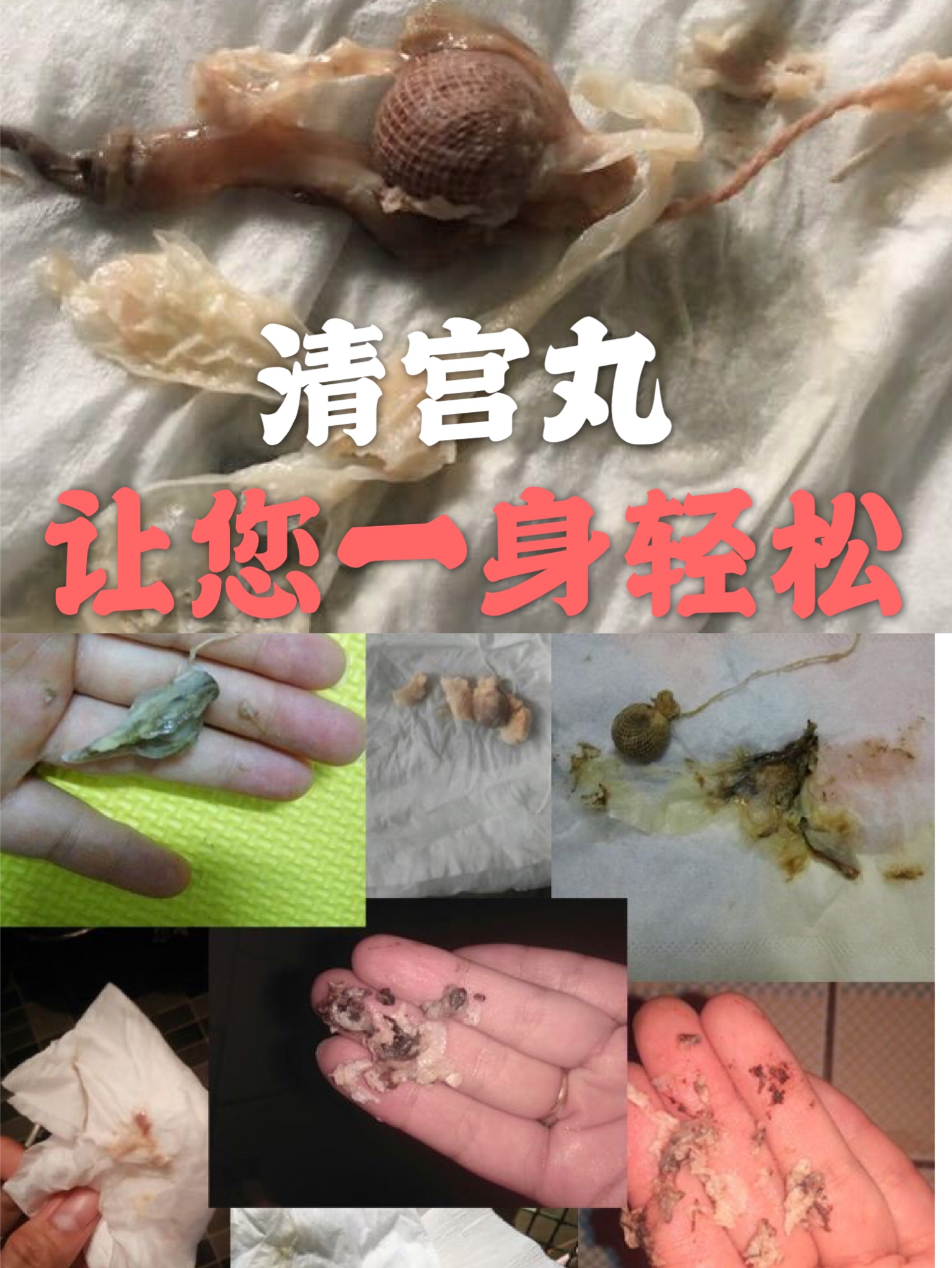 清宫丸排出白皮的照片图片