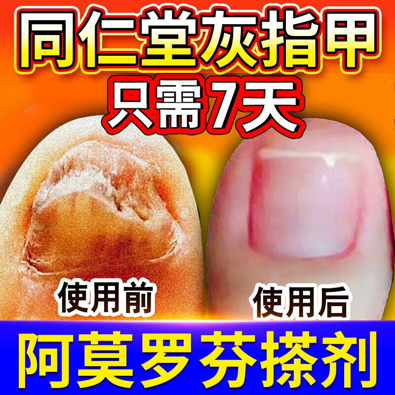 阿莫罗芬搽剂灰指甲专用正品旗舰店修复脱甲膏真菌感染抑菌液去甲