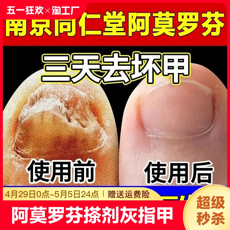 阿莫罗芬搽剂灰指甲治療专用正品旗舰店修复脱甲膏真菌感染抑菌液