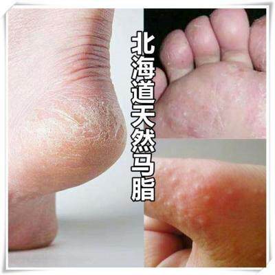 搜索"脚裂膏后跟龟裂"的优惠券结果页-搜券网