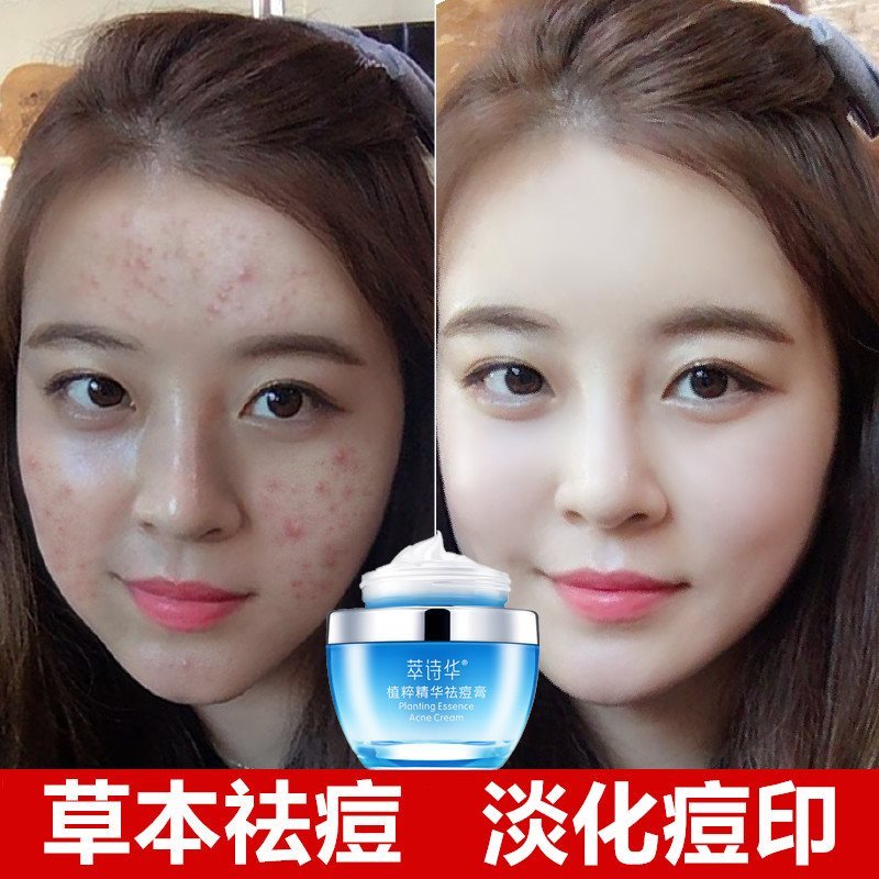 去 背后痘印 偏方_去痘印最有效的偏方_去下巴痘印偏方