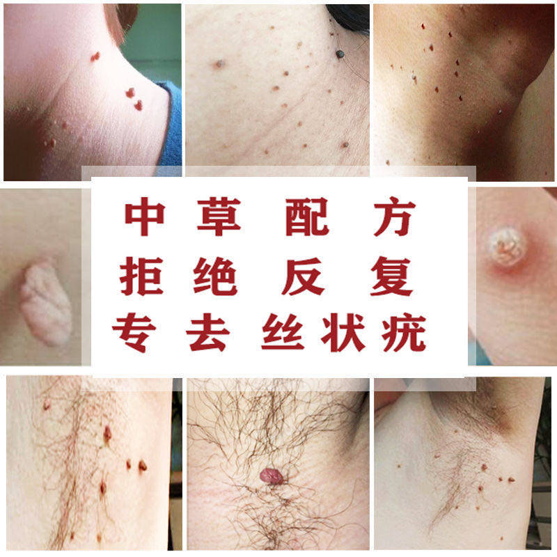 滴优去肉刺猴子特效除尤净