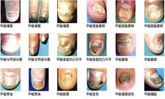 正品外用  灰甲清软甲膏亮甲灰甲净涨甲水病甲药水增厚甲2赠1包邮