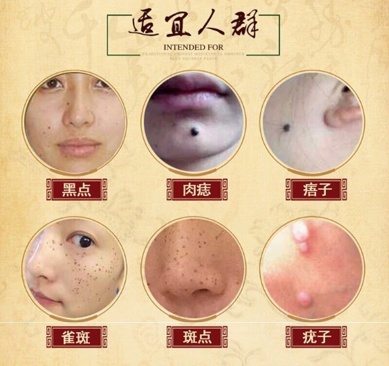 热销去志点神器_去脸上黑点神器脸部凸痣祛痦子点斑水点雀斑膏志无痕