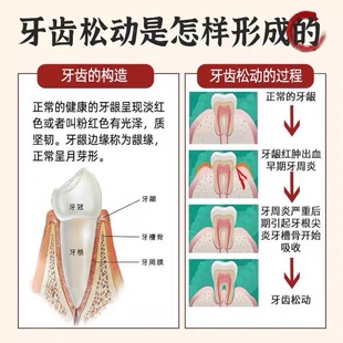 推荐【重度牙龈萎缩】牙齿松动专用牙膏牙晃动修复牙龈肿痛酸软出