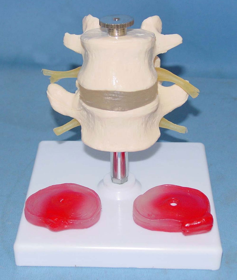 可拆2节腰椎带2个病变椎间盘突出模型骨骼骨架医用X教学病理讲解