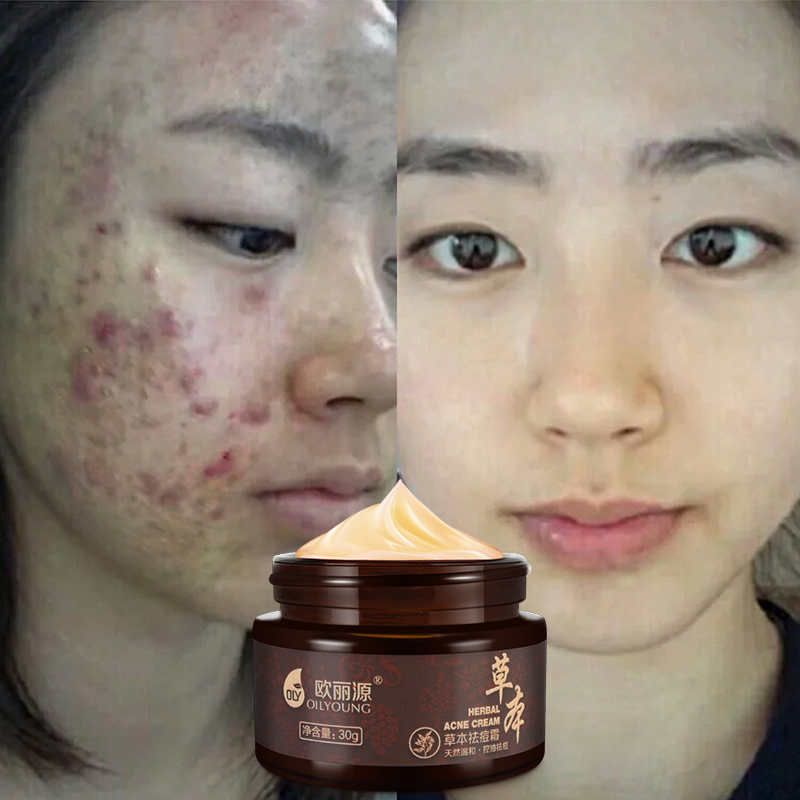 红色痘印和痘坑去不掉_去痘印最有效的偏方_怎么去痘坑痘印