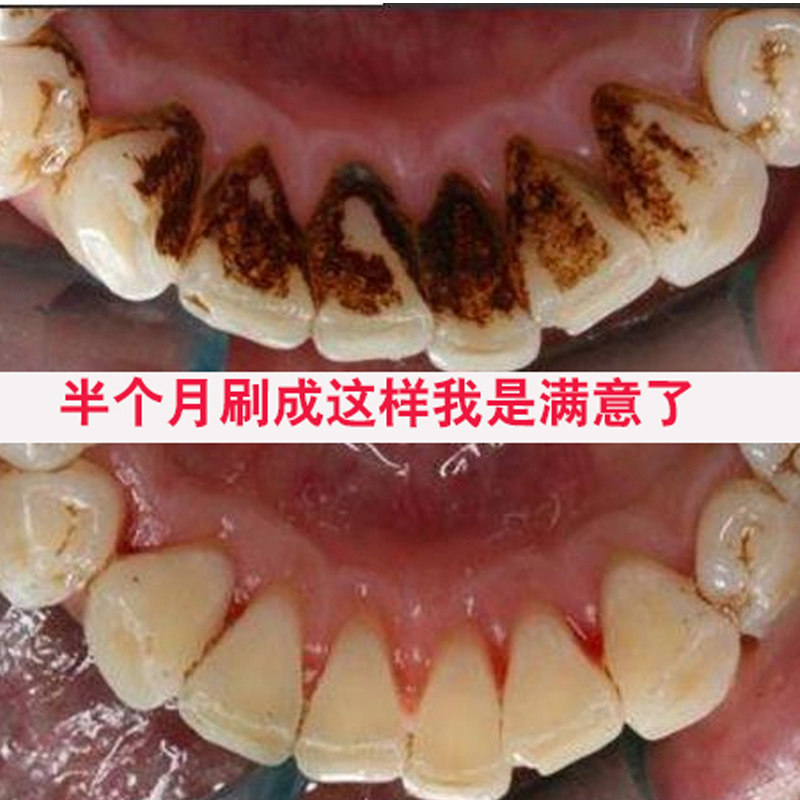 口益清烟渍净牙膏去烟渍神器美白去除烟渍牙膏去牙渍黄牙买2送1