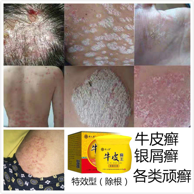 牛皮癣断根神经性皮炎进口外用膏湿疹止痒去根体股癣抑菌止痒要膏