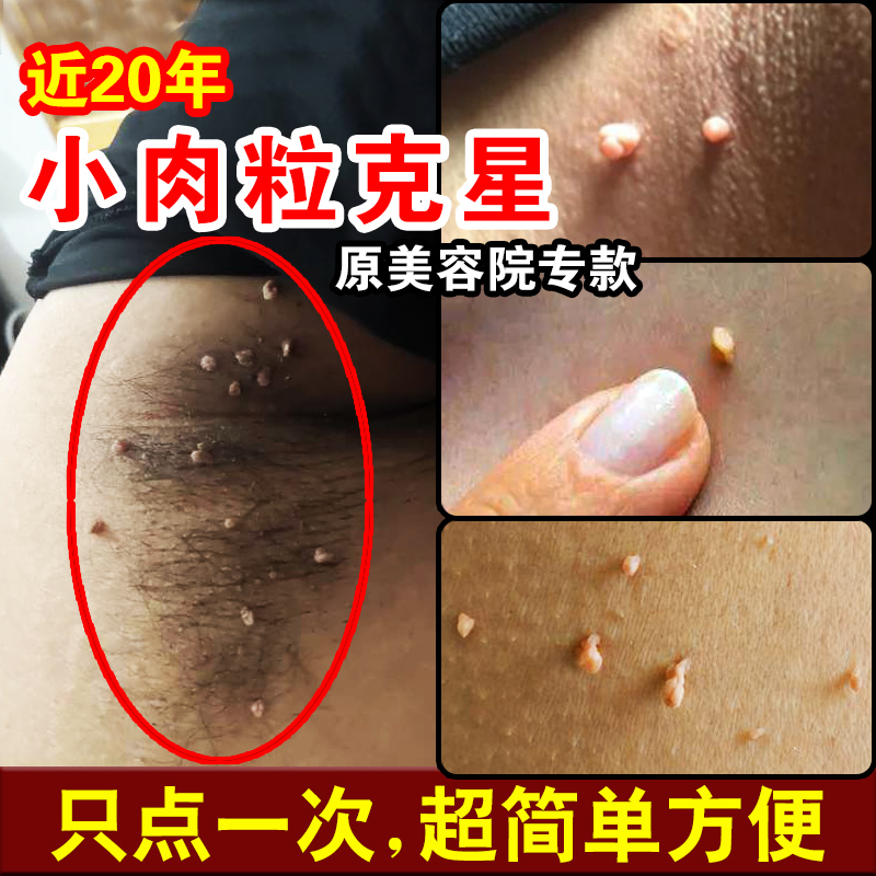 5五氟尿嘧啶软膏旗舰店正品丝状疣5fu5佛五氟脲嘧啶软膏乳膏