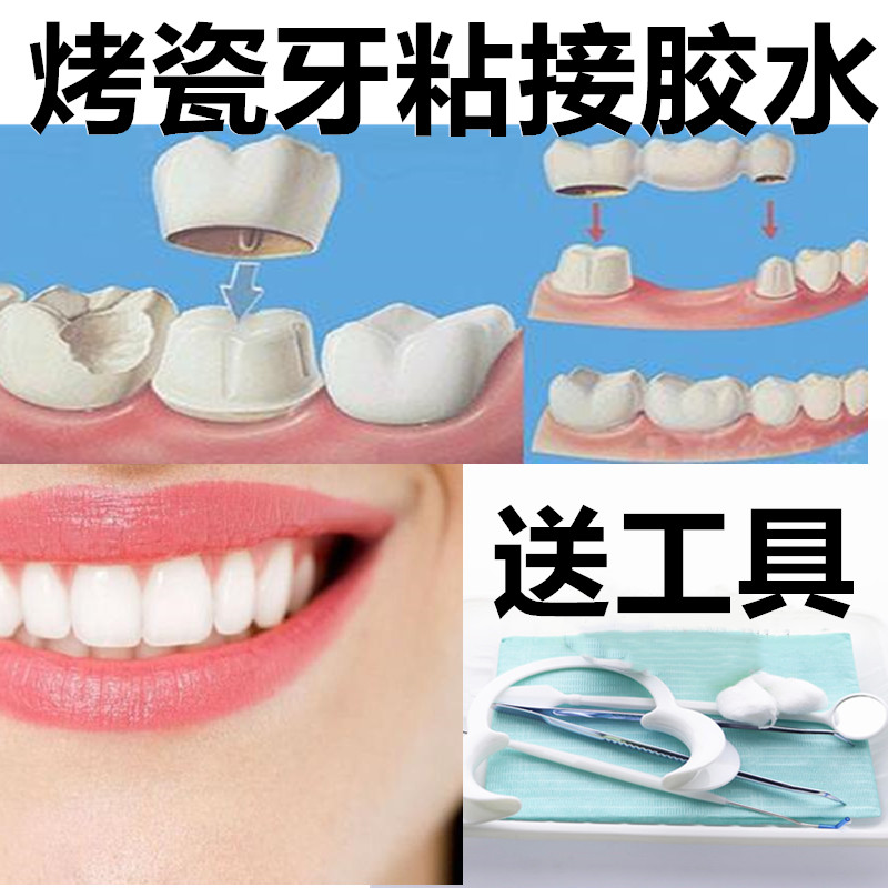 牙医自己烤瓷牙粘接剂烤瓷牙冠假牙套粘接蛀牙自己补牙洞胶水