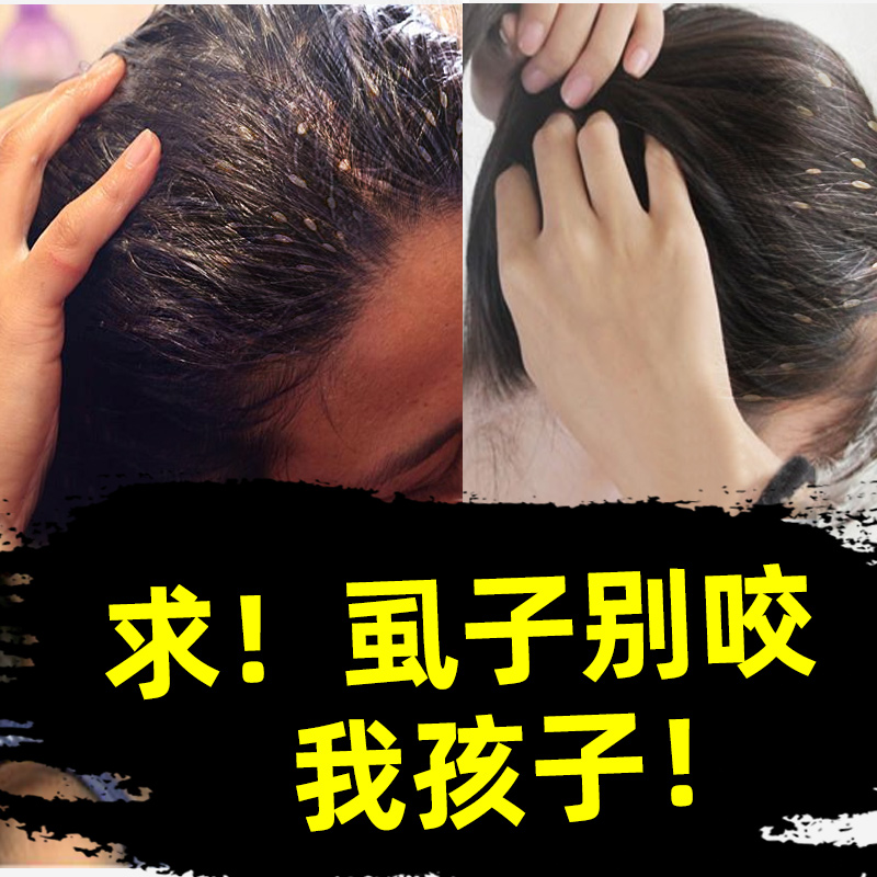 儿童虱子药头虱子小女孩头发体外驱虫虱子梳药虱子大人用一扫光去