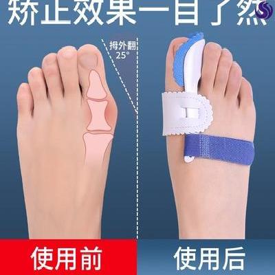母外翘重叠矫正器大脚指拇外翻夜日用脚拐骨畸形脚足部外翻矫形.