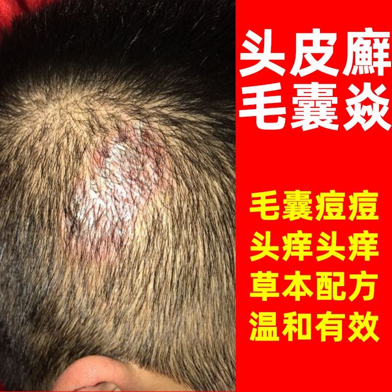 鲜药膏真菌感染头皮真菌感染洗发水独家草本药膏头皮藓牛皮癣用药
