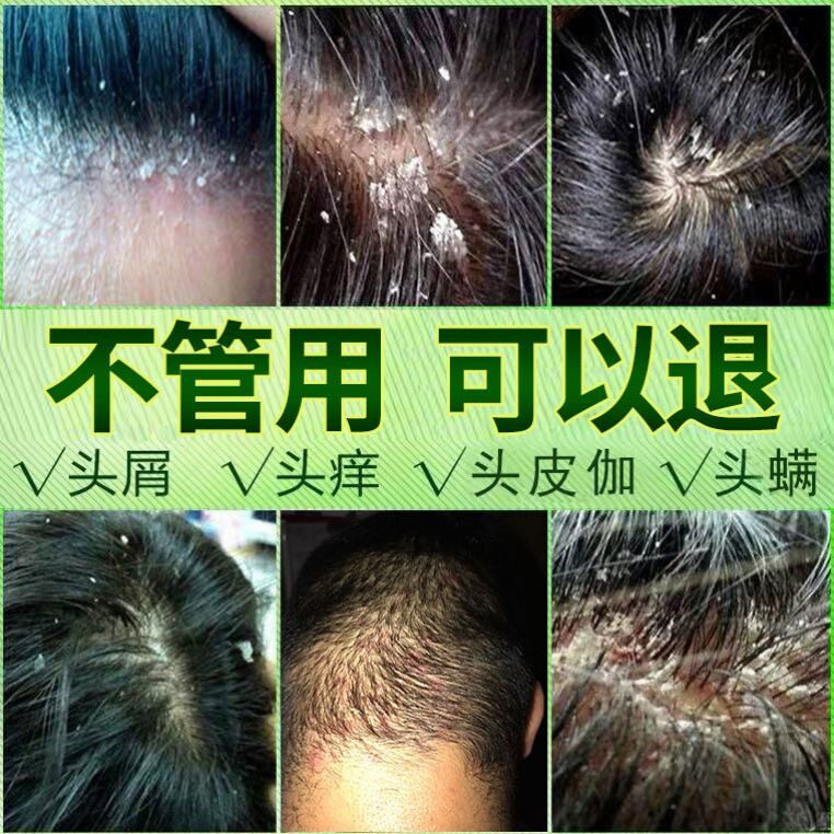 去头屑医药治严重头皮屑专用的药去屑止痒控油洗发水男女正品