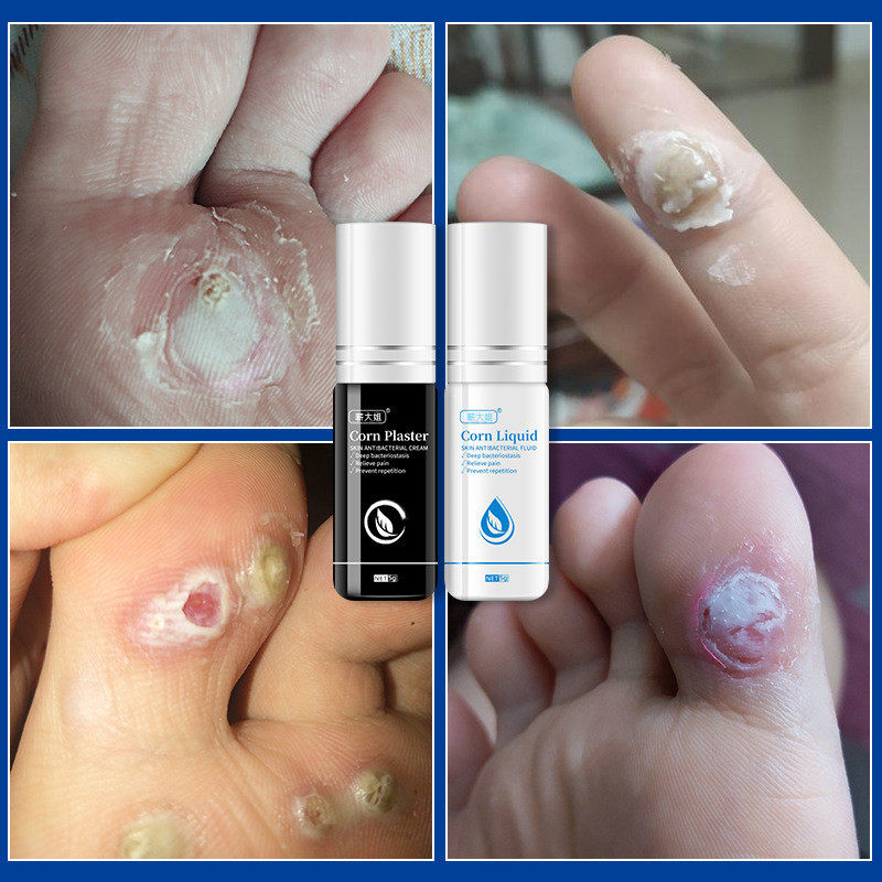 点痣去痣水水点水祛痣痦子黑点痦子凸痣黑痣苍蝇屎痣缘宫脸部无膏