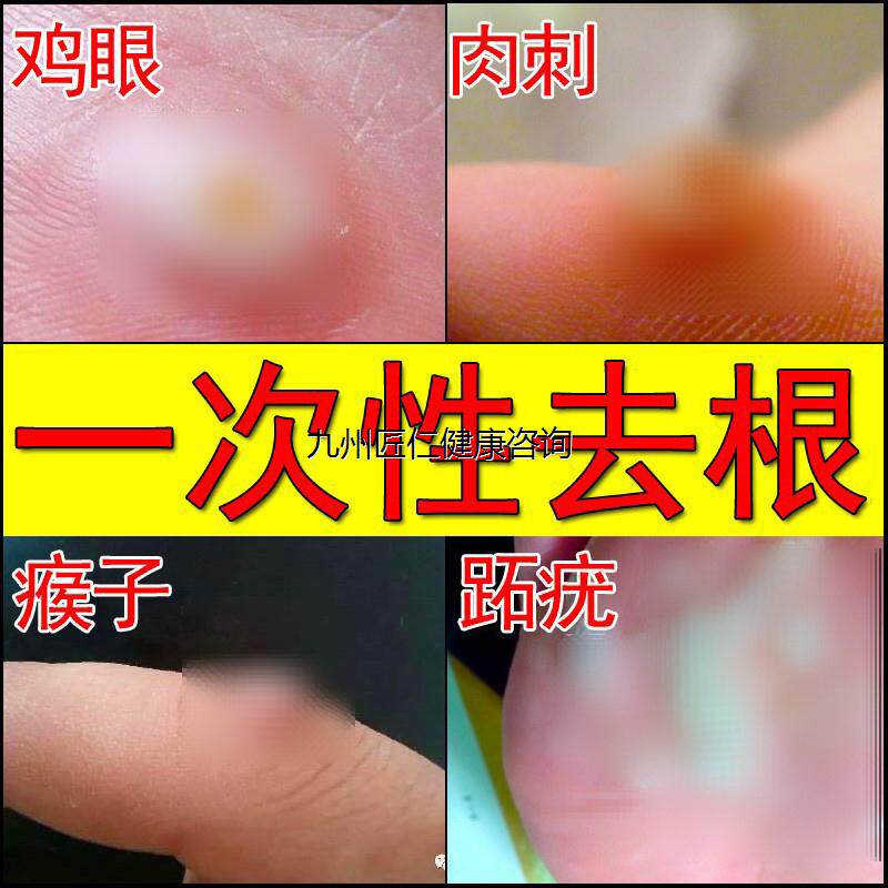 云南白白药鸡眼膏贴专新款中国大陆肉刺跖疣修白正云脚山医生