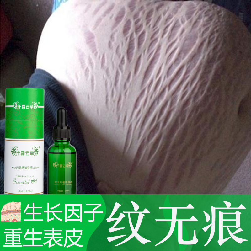妊娠纹产后不要纹淡化妊娠纹油去肥胖纹大腿生长纹膨胀纹修复产品