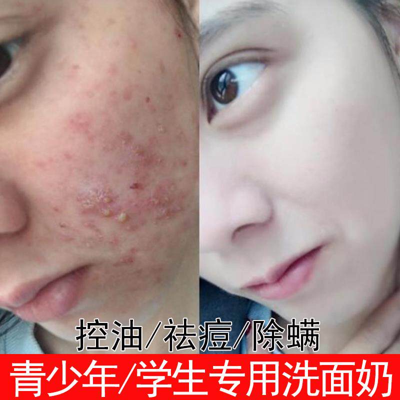 一折除痘洗面奶_祛痘洗面奶青春痘去豆控油性皮肤痘痘肌除痘螨虫男童