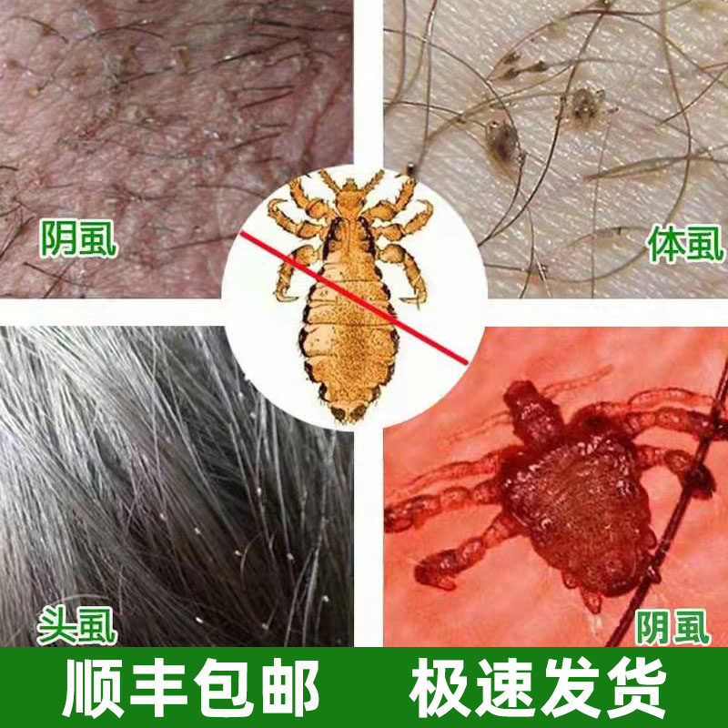 灭虱灵_阴虱药百部酊男士用喷剂女私处去虱子药一扫光除虱卵阴虱净灭