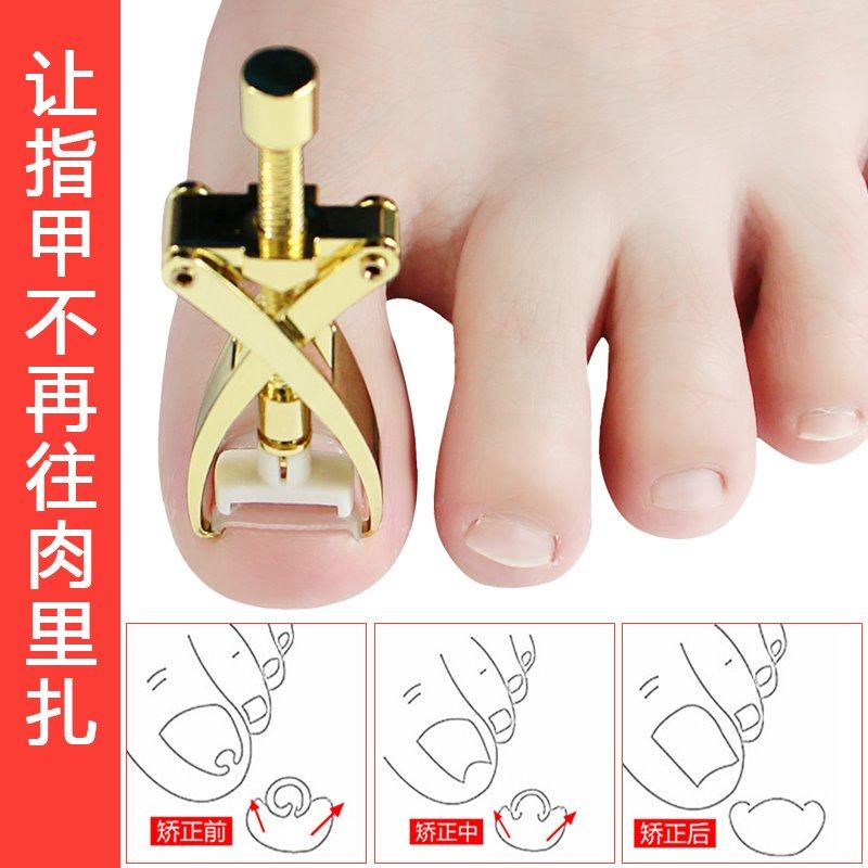 甲沟炎矫正器翘甲器_第三代脚指甲矫正器甲沟用剔翘甲器修脚用炎金属