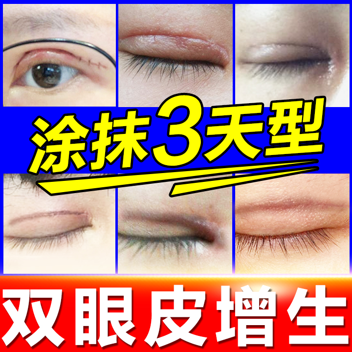 双眼皮祛疤贴疤痕增生修复去疤膏开眼