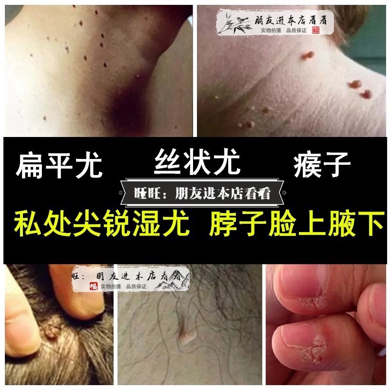 丝状皮赘犹毒鬼臼肛门外阴私处尖锐肉粒疙瘩畜牧