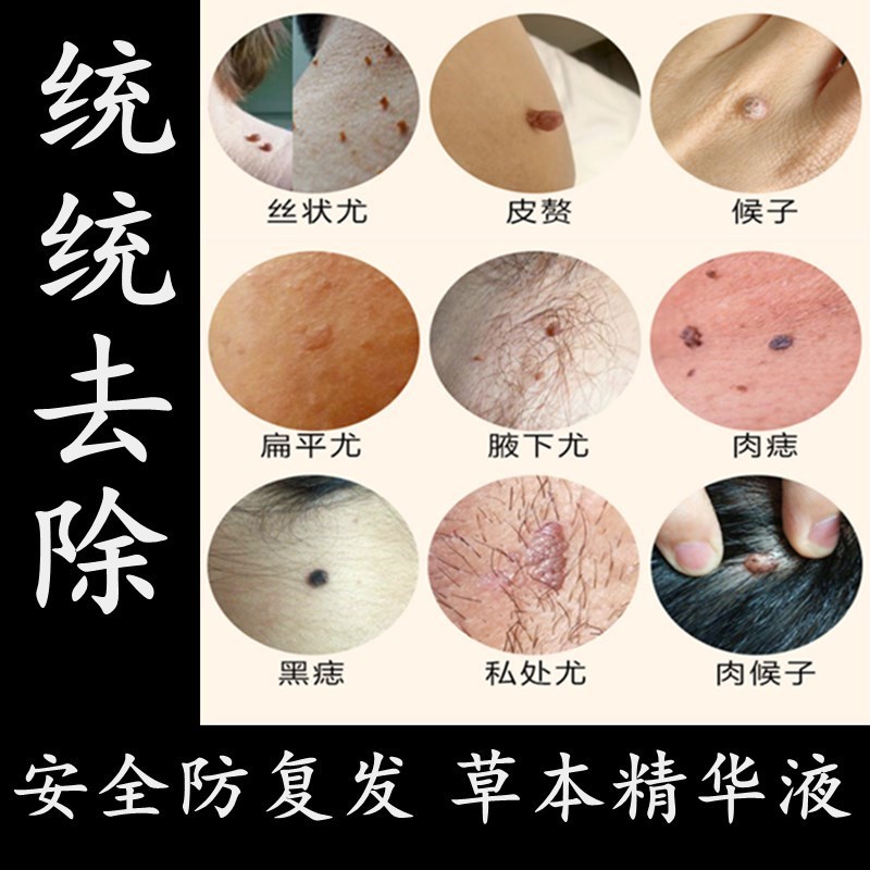 丝状疣去除膏日本