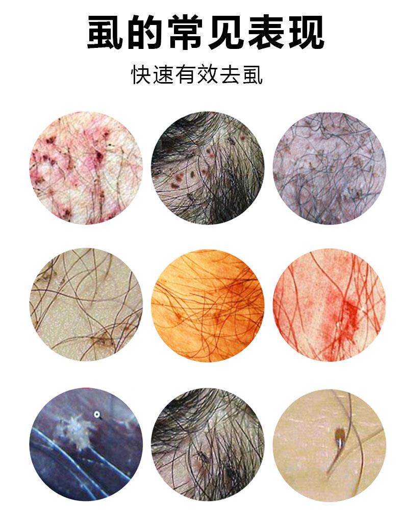 去虱_去阴o5682虱子成人处治百阴狮子阴毛卵衣虱体虱虫痒的药百部私町