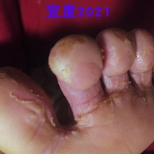 脚丫子痒烂脚脚气优昌中华医道软膏 抑菌止痒药膏【买2送1、3送2