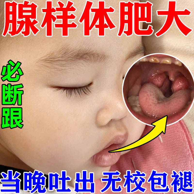 腺样体肥大中药贴调理儿童小孩睡觉张嘴打呼噜嘴唇上翘面容矫正器