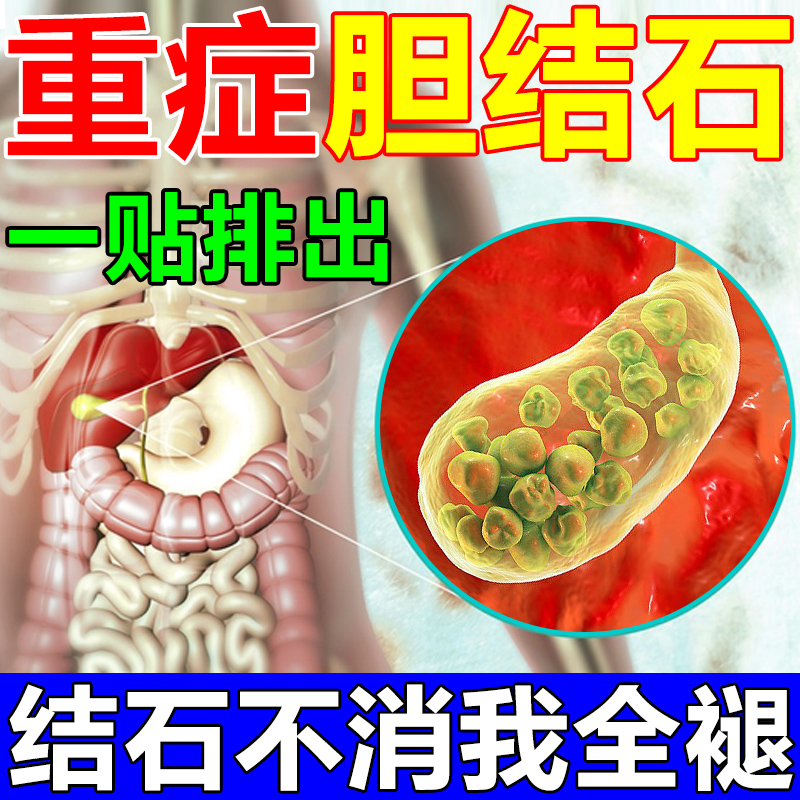 治疗胆结石溶石化石排石特效专用药鸡内金胆囊炎胆囊息肉中草药贴