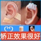 新生儿耳朵矫正器婴儿宝宝儿童耳廓塑形耳夹硅胶耳撑外耳定型耳贴