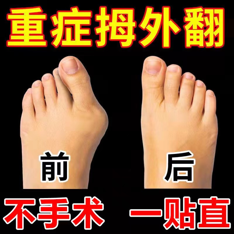 【最快三天】拇指外翻矫正神器女大脚拇指外翻脚趾重叠疼痛膏药贴