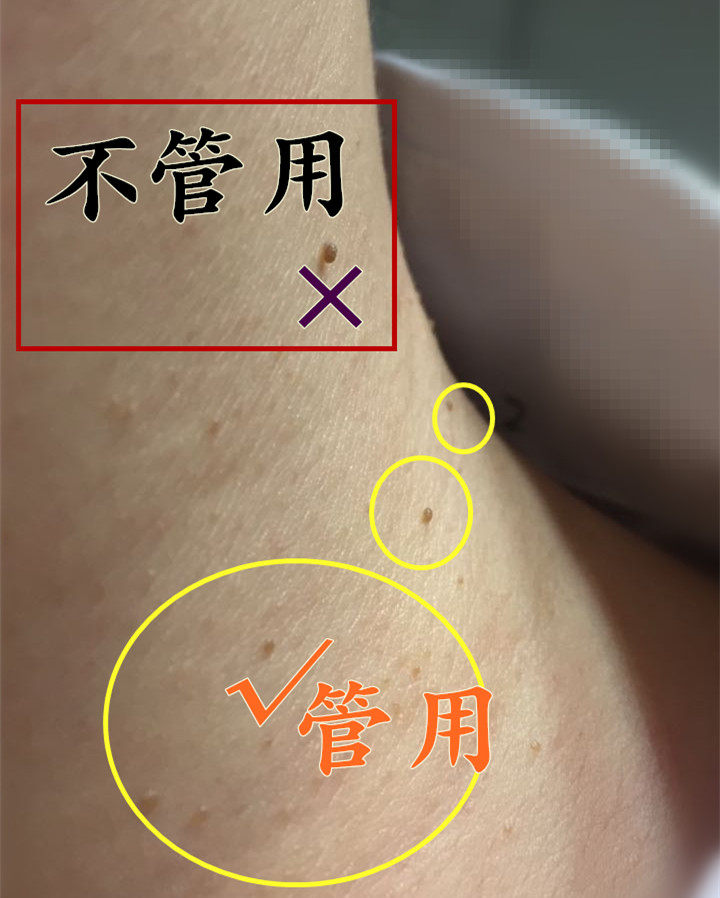 激光去皮赘多少钱 激光肉赘医保