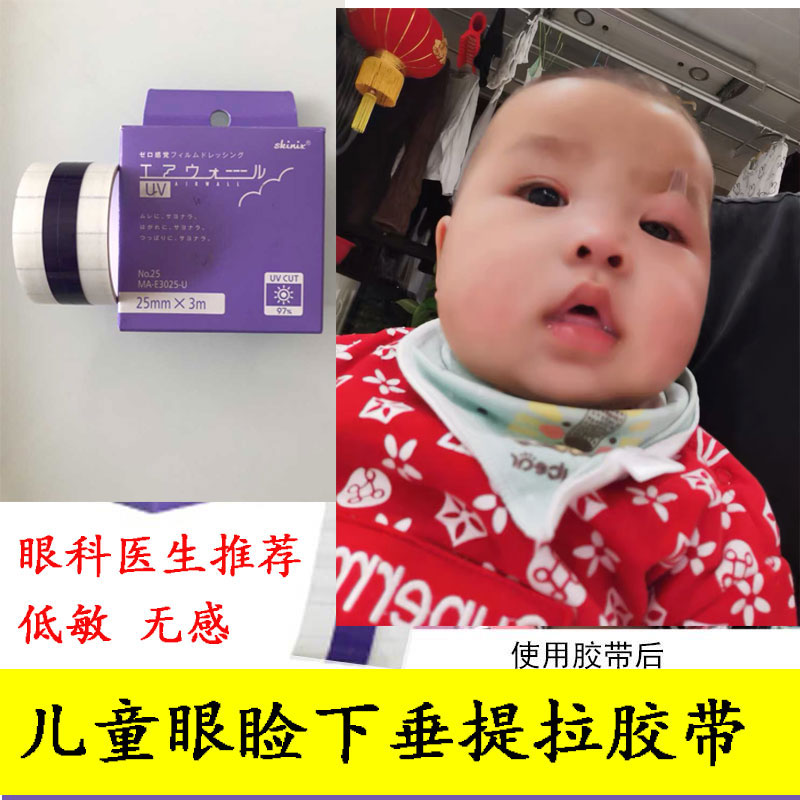 小孩上眼睑下垂肌无力眼贴悬吊婴儿保护视力胶带宝宝提拉眼皮胶布