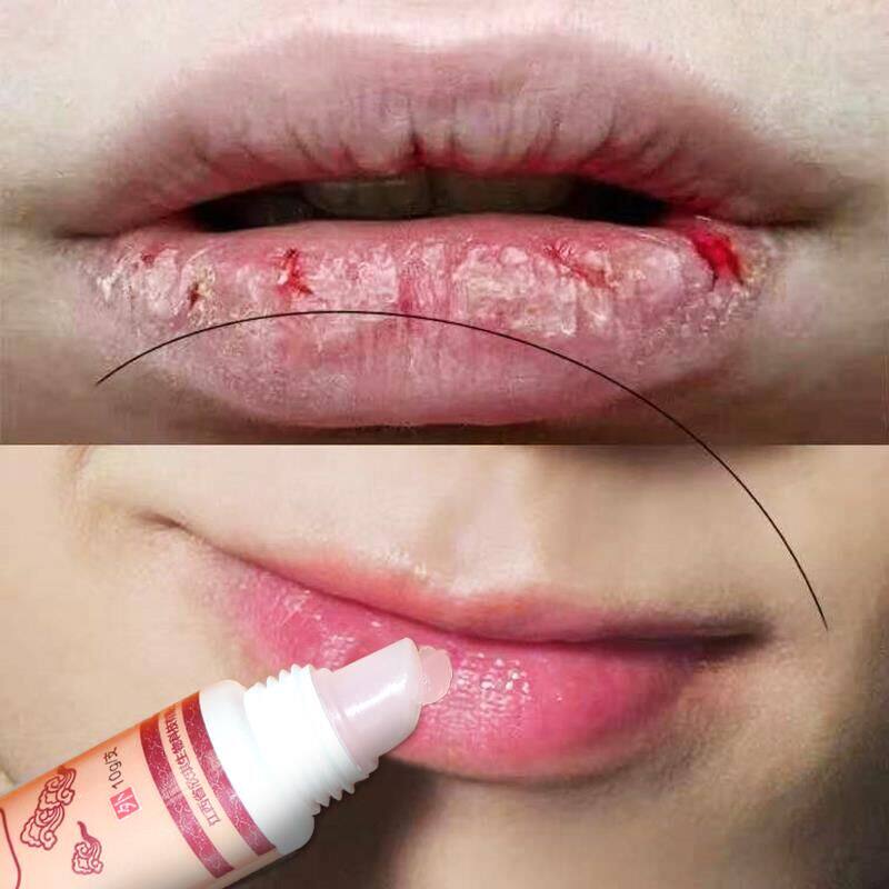 烂嘴角优惠专场