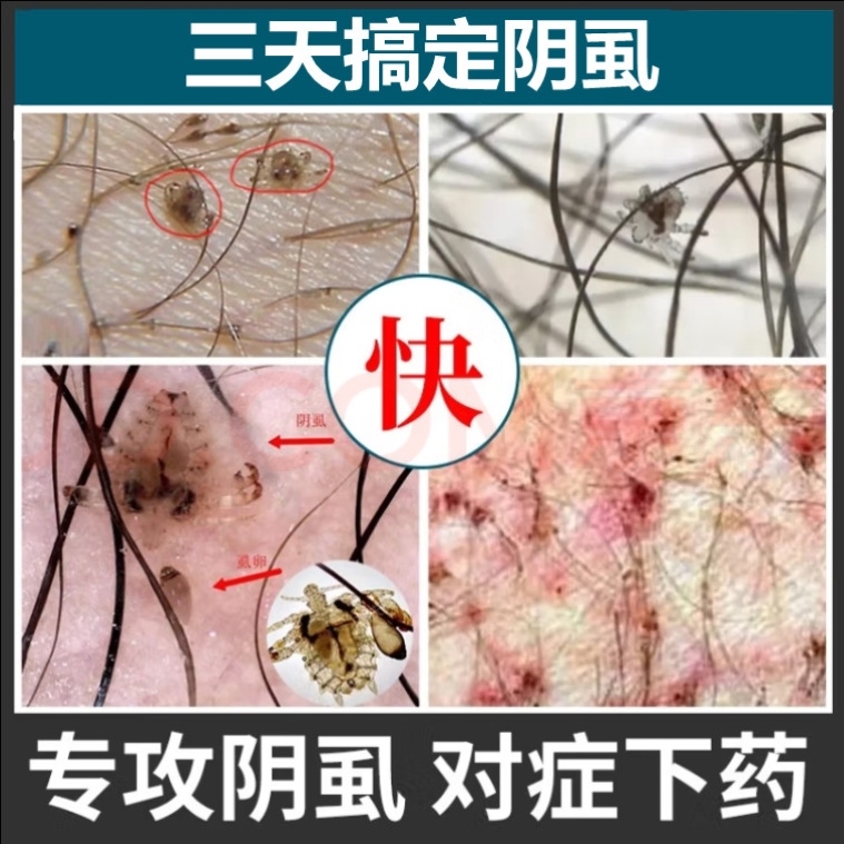 三分钟完全去除阴虱卵图片