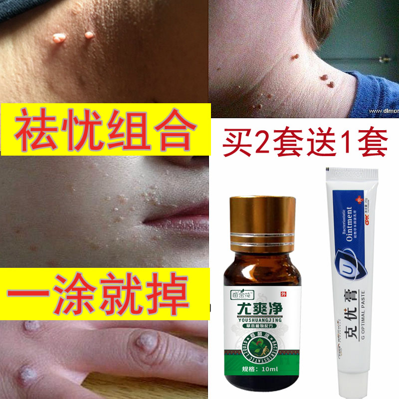 疣克舒软膏草本克疣霜尤克舒扁平 病毒疣丝状疣寻常疣脚刺瘊子肉