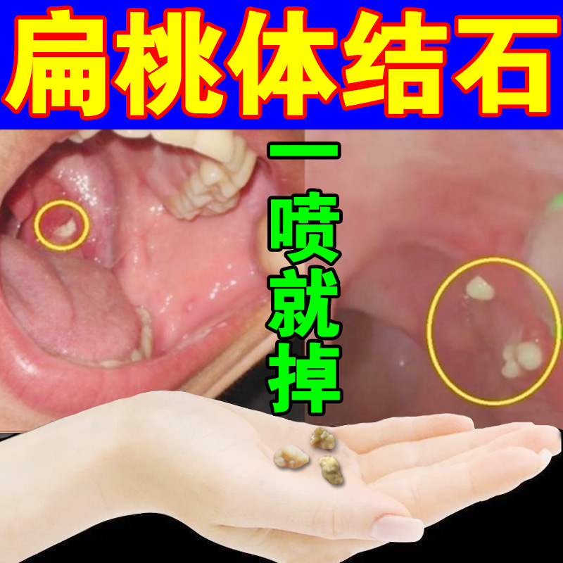 扁桃体结石去除工具