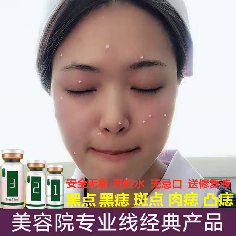 点脸部痣斑药水取雀斑净黑点遗传斑无痕正品美容院专用去痦子痣膏