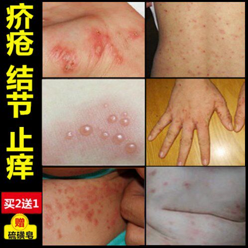疥疮结节霜虱疥止痒灵去根大腿内侧阴囊瘙痒正品男女皮肤抑菌药膏