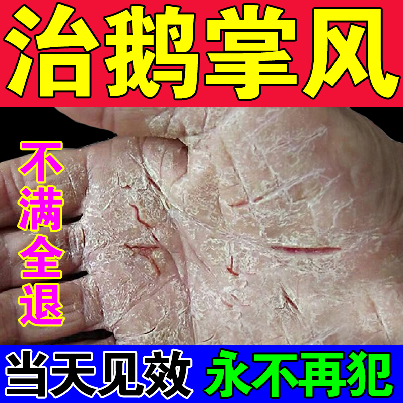 鹅掌风能根治吗图片