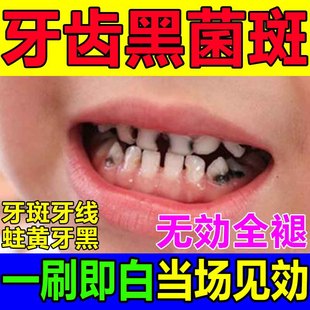 儿童牙菌斑祛除神器去黑色素沉淀清洁黑斑牙黄牙污渍速效美白牙齿