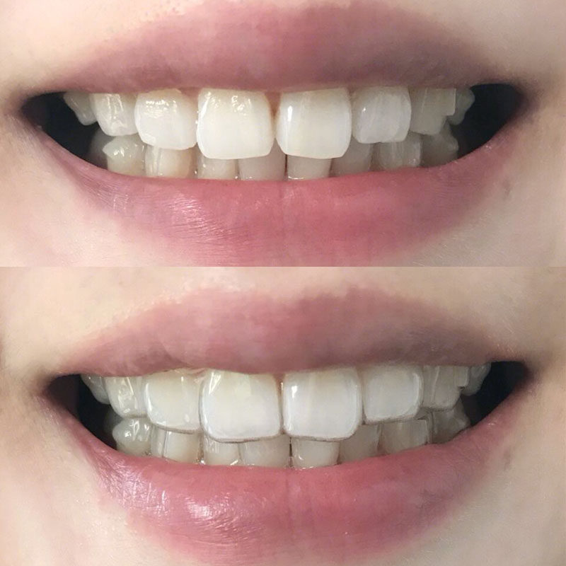 整牙齿 矫正器 成人 保持器