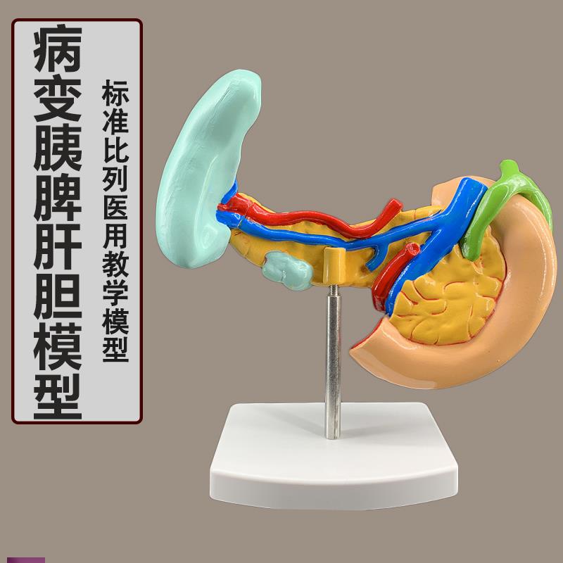 病变胰脾肝d胆十二指肠模型病理标本胰脾肝胆人体器官解剖教学模